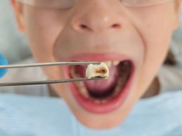 Best Emergency Cosmetic Dentistry (e.g., broken veneers) in El Dorado Springs, MO